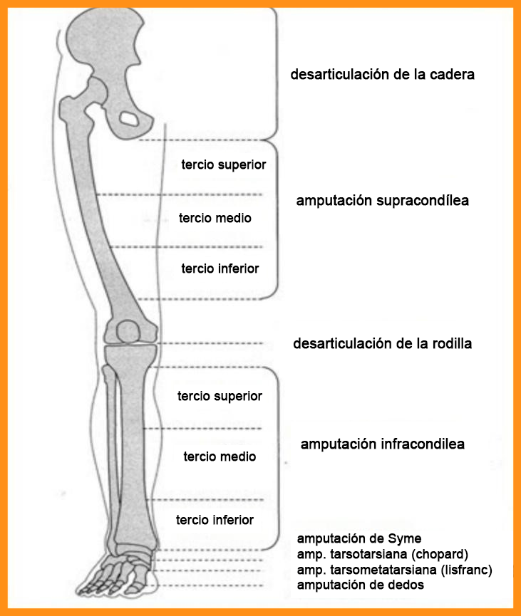 amputación pierna